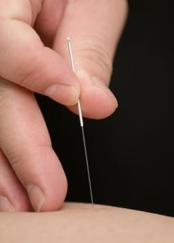 Acupuncture ballinasloe