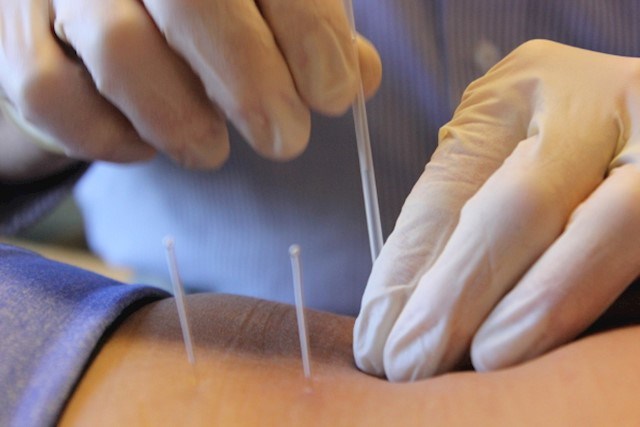 Image of dry needling in Cavan being carried out by Geraldine Farrelly Brady Physical Therapy, muscular pain relief through dry needling is available from Geraldine Farrelly Brady Physical Therapy