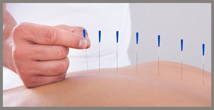 Dry needling in Ardee is carried out by Body Mechanics Clinic