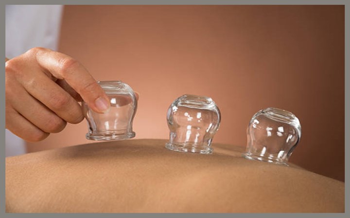 Cupping treatments in Ardee are carried out by Body Mechanics Clinic